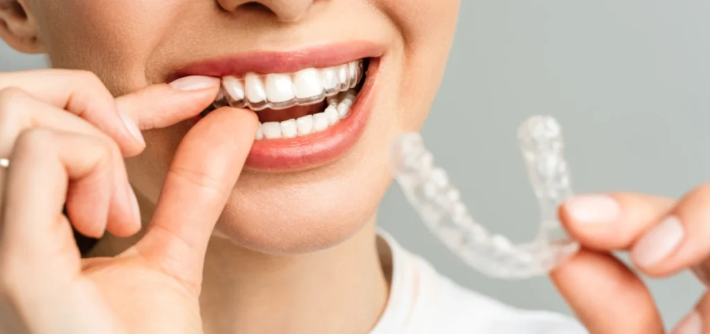 aligneur invisible orthodontie Orthodontiste adulte Troyes