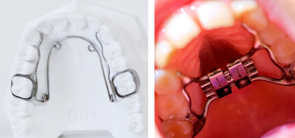 orthodontie enfant disjoncteur quad helix plaque palatine orthodontie Orthodontiste enfant Troyes