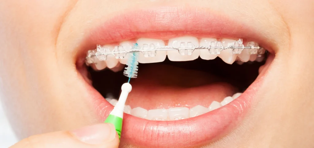 orthodontie hygiene bucco dentaire